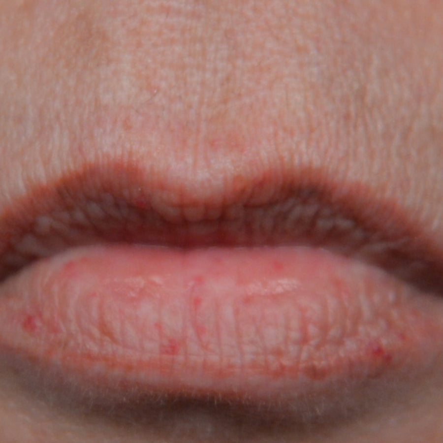Kiss Lip Treatment, before